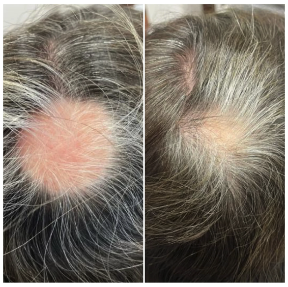 Calecim Advanced Hair System Kit 6 x ml results