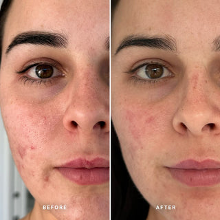 Alpha-H Clear Skin Tonic før og efter resultat tre