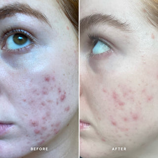 Alpha-H Clear Skin Tonic før og efter resultat to