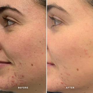 Alpha-H Clear Skin Tonic før og efter resultat fire