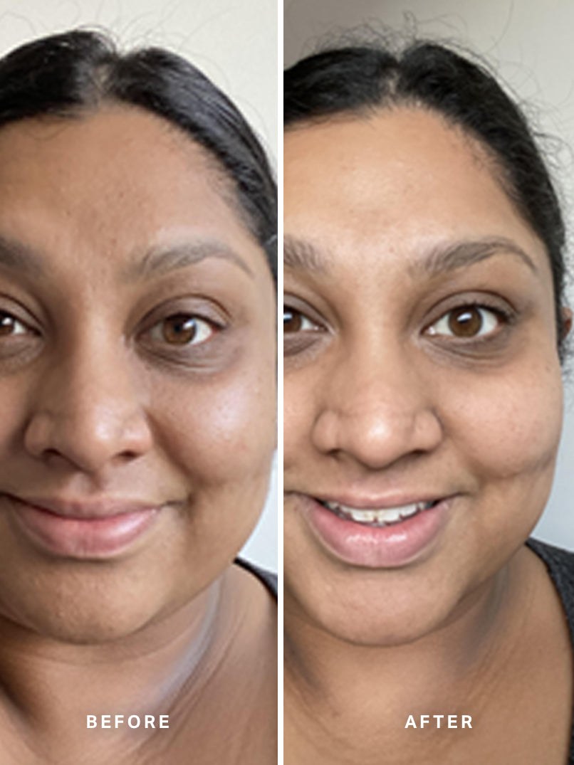 Alpha-H Liquid Gold Exfoliating Treatment før og efter resultat fire