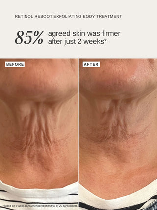 Alpha-H Retinol Reboot Exfoliating Body Treatment før og efter fastere hud