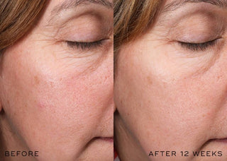 Medik8 r-Retinoate Intense - Night cream før og efter
