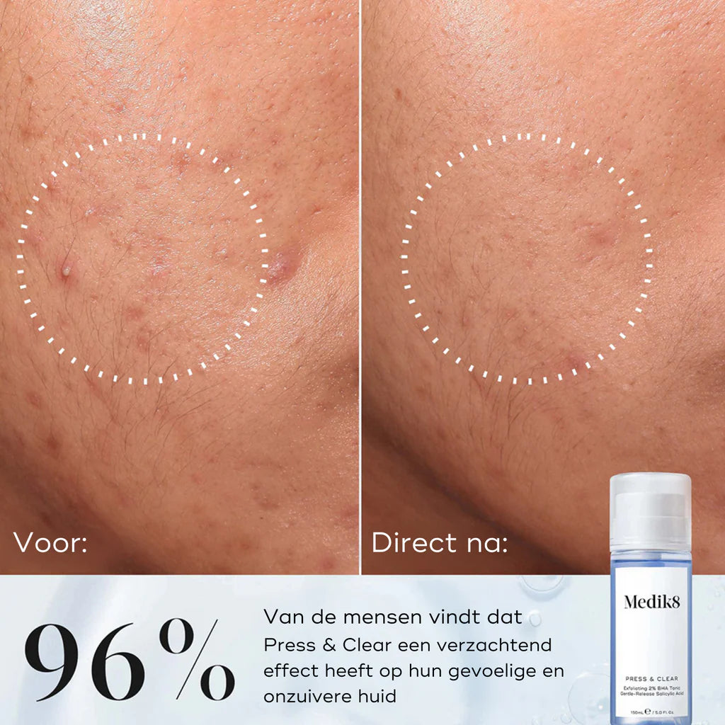 Medik8 Press & Clear før og efter, 96 % ser en straks beroligende effekt