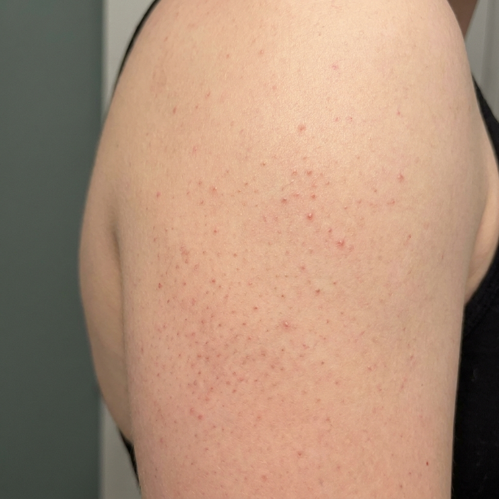 Keratosis pilaris: gør gåsehudsbumperne glattere